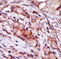 CIB2 / KIP2 Antibody - Formalin-fixed and paraffin-embedded human cancer tissue reacted with the primary antibody, which was peroxidase-conjugated to the secondary antibody, followed by AEC staining. This data demonstrates the use of this antibody for immunohistochemistry; clinical relevance has not been evaluated. BC = breast carcinoma; HC = hepatocarcinoma.