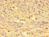 CKAP2L Antibody - Immunohistochemistry of paraffin-embedded human melanoma cancer at dilution of 1:100
