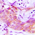 CKLFSF4 / CMTM4 Antibody - Immunohistochemical analysis of CMTM4 staining in human prostate cancer formalin fixed paraffin embedded tissue section. The section was pre-treated using heat mediated antigen retrieval with sodium citrate buffer (pH 6.0). The section was then incubated with the antibody at room temperature and detected with HRP and DAB as chromogen. The section was then counterstained with hematoxylin and mounted with DPX.