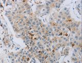 CKMT1A Antibody - Immunohistochemistry of paraffin-embedded Human lung cancer using CKMT1A/CKMT1B Polyclonal Antibody at dilution of 1:100.