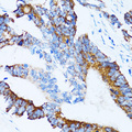 CLDN11 / Claudin 11 Antibody - Immunohistochemistry of paraffin-embedded human colon carcinoma tissue.