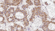 CLDN14 / Claudin 14 Antibody - 1:100 staining human liver carcinoma tissues by IHC-P. The sample was formaldehyde fixed and a heat mediated antigen retrieval step in citrate buffer was performed. The sample was then blocked and incubated with the antibody for 1.5 hours at 22°C. An HRP conjugated goat anti-rabbit antibody was used as the secondary.
