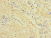 CLDN18 / Claudin 18 Antibody - Immunohistochemistry of paraffin-embedded human pancreatic cancer at dilution 1:100