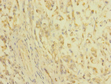 CLDN18 / Claudin 18 Antibody - Immunohistochemistry of paraffin-embedded human gastric cancer at dilution 1:100
