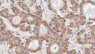 CLDN23 / Claudin 23 Antibody - 1:100 staining human liver carcinoma tissues by IHC-P. The sample was formaldehyde fixed and a heat mediated antigen retrieval step in citrate buffer was performed. The sample was then blocked and incubated with the antibody for 1.5 hours at 22°C. An HRP conjugated goat anti-rabbit antibody was used as the secondary.