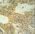 CLDN23 / Claudin 23 Antibody - CLDN23 Antibody IHC of formalin-fixed and paraffin-embedded colon carcinoma followed by peroxidase-conjugated secondary antibody and DAB staining.