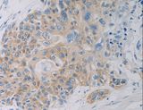 CLEC4C / CD303 / BDCA-2 Antibody - Immunohistochemistry of paraffin-embedded Human esophagus cancer using CLEC4C Polyclonal Antibody at dilution of 1:50.