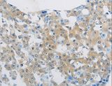 CLEC4C / CD303 / BDCA-2 Antibody - Immunohistochemistry of paraffin-embedded Human breast cancer using CLEC4C Polyclonal Antibody at dilution of 1:70.