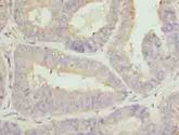 CLGN / Calmegin Antibody - Immunohistochemistry of paraffin-embedded human endometrial cancer using antibody at dilution of 1:100.