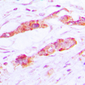 CLIC4 Antibody - Immunohistochemical analysis of CLIC4 staining in human lung cancer formalin fixed paraffin embedded tissue section. The section was pre-treated using heat mediated antigen retrieval with sodium citrate buffer (pH 6.0). The section was then incubated with the antibody at room temperature and detected using an HRP conjugated compact polymer system. DAB was used as the chromogen. The section was then counterstained with hematoxylin and mounted with DPX.