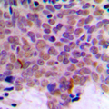CLK1 / CLK Antibody - Immunohistochemical analysis of CLK1 staining in human breast cancer formalin fixed paraffin embedded tissue section. The section was pre-treated using heat mediated antigen retrieval with sodium citrate buffer (pH 6.0). The section was then incubated with the antibody at room temperature and detected using an HRP conjugated compact polymer system. DAB was used as the chromogen. The section was then counterstained with hematoxylin and mounted with DPX. w
