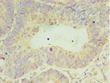 CLK2 Antibody - Immunohistochemistry of paraffin-embedded human colon cancer using antibody at 1:100 dilution.