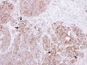 CLLP / CTNNAL1 Antibody - IHC of paraffin-embedded SW480 xenograft using Alpha-catulin antibody at 1:100 dilution.