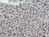 CLP1 Antibody - IHC of paraffin-embedded HS578T xenograft using CLP1 antibody at 1:100 dilution.