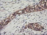 CLPP Antibody - IHC of paraffin-embedded Carcinoma of Human pancreas tissue using anti-CLPP mouse monoclonal antibody.