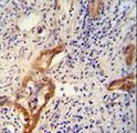 CLPX Antibody - CLPX antibody immunohistochemistry of formalin-fixed and paraffin-embedded human hepatocarcinoma followed by peroxidase-conjugated secondary antibody and DAB staining.