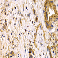 CLU / Clusterin Antibody - Immunohistochemistry of paraffin-embedded human gastric cancer using CLU antibodyat dilution of 1:200 (40x lens).