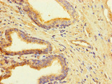 CLUAP1 Antibody - Immunohistochemistry of paraffin-embedded human prostate cancer using CLUAP1 Antibody at dilution of 1:100