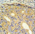 CNBP / ZNF9 Antibody - ZNF9 Antibody IHC of formalin-fixed and paraffin-embedded prostate carcinoma followed by peroxidase-conjugated secondary antibody and DAB staining.