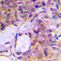 CNKSR2 Antibody - Immunohistochemical analysis of CNK2 staining in human breast cancer formalin fixed paraffin embedded tissue section. The section was pre-treated using heat mediated antigen retrieval with sodium citrate buffer (pH 6.0). The section was then incubated with the antibody at room temperature and detected using an HRP conjugated compact polymer system. DAB was used as the chromogen. The section was then counterstained with hematoxylin and mounted with DPX. w