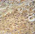 CNNM4 Antibody - CNNM4 Antibody immunohistochemistry of formalin-fixed and paraffin-embedded human lung carcinoma followed by peroxidase-conjugated secondary antibody and DAB staining.