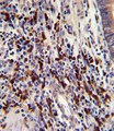 CNOT8 Antibody - Formalin-fixed and paraffin-embedded human colon carcinoma with CNOT8 Antibody , which was peroxidase-conjugated to the secondary antibody, followed by DAB staining. This data demonstrates the use of this antibody for immunohistochemistry; clinical relevance has not been evaluated.
