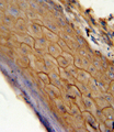 CNR2 / CB2 Antibody - CB2 antibody immunohistochemistry of formalin-fixed and paraffin-embedded human skin carcinoma followed by peroxidase-conjugated secondary antibody and DAB staining.