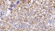 CNTF Antibody - 1:100 staining human Melanoma tissue by IHC-P. The sample was formaldehyde fixed and a heat mediated antigen retrieval step in citrate buffer was performed. The sample was then blocked and incubated with the antibody for 1.5 hours at 22°C. An HRP conjugated goat anti-rabbit antibody was used as the secondary.