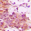 CNTROB Antibody - Immunohistochemical analysis of CNTROB staining in human breast cancer formalin fixed paraffin embedded tissue section. The section was pre-treated using heat mediated antigen retrieval with sodium citrate buffer (pH 6.0). The section was then incubated with the antibody at room temperature and detected with HRP and DAB as chromogen. The section was then counterstained with hematoxylin and mounted with DPX.