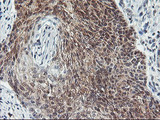 COASY Antibody - IHC of paraffin-embedded Carcinoma of Human bladder tissue using anti-COASY mouse monoclonal antibody.