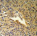 COG2 Antibody - COG2 Antibody (RB17913) IHC of formalin-fixed and paraffin-embedded human Lung carcinoma followed by peroxidase-conjugated secondary antibody and DAB staining.
