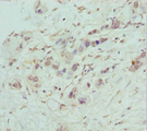COG5 Antibody - Immunohistochemistry of paraffin-embedded human pancreatic cancer at dilution 1:100