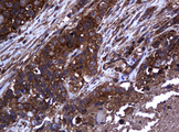 COG6 Antibody - IHC of paraffin-embedded Adenocarcinoma of Human colon tissue using anti-COG6 mouse monoclonal antibody. (Heat-induced epitope retrieval by 10mM citric buffer, pH6.0, 120°C for 3min).