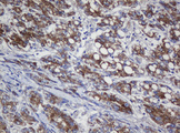 COG6 Antibody - IHC of paraffin-embedded Carcinoma of Human liver tissue using anti-COG6 mouse monoclonal antibody. (Heat-induced epitope retrieval by 10mM citric buffer, pH6.0, 120°C for 3min).