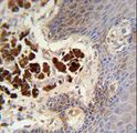COL19A1 / Collagen XIX Antibody - COL19A1 antibody immunohistochemistry of formalin-fixed and paraffin-embedded human skin carcinoma followed by peroxidase-conjugated secondary antibody and DAB staining.