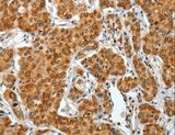 COL1A2 / Collagen I Alpha 2 Antibody - Immunohistochemistry of paraffin-embedded Human lung cancer using COL1A2 Polyclonal Antibody at dilution of 1:70.