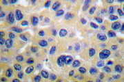 COL2A1 / Collagen II Alpha 1 Antibody - IHC of Collagen II (P133) pAb in paraffin-embedded human breast carcinoma tissue.