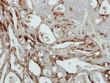 COL3A1 / Collagen III Antibody - IHC of paraffin-embedded NCIN87 xenograft using Collagen III alpha1 antibody at 1:500 dilution.
