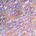 COL3A1 / Collagen III Antibody - Immunohistochemical analysis of Collagen 3 alpha 1 staining in human breast cancer formalin fixed paraffin embedded tissue section. The section was pre-treated using heat mediated antigen retrieval with sodium citrate buffer (pH 6.0). The section was then incubated with the antibody at room temperature and detected using an HRP conjugated compact polymer system. DAB was used as the chromogen. The section was then counterstained with hematoxylin and mounted with DPX.