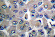 COL4A1 / Collagen IV Alpha1 Antibody - IHC of Collagen IV (G46) pAb in paraffin-embedded human breast carcinoma tissue.