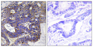 COL4A2 / Collagen IV Alpha2 Antibody - Immunohistochemistry analysis of paraffin-embedded human colon carcinoma tissue, using Collagen IV alpha2 Antibody. The picture on the right is blocked with the synthesized peptide.