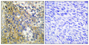 COL4A6 / Collagen IV Antibody - Immunohistochemistry analysis of paraffin-embedded human cervix carcinoma tissue, using Collagen IV alpha6 Antibody. The picture on the right is blocked with the synthesized peptide.