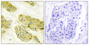 COL5A3 / Collagen V Alpha 3 Antibody - Immunohistochemistry analysis of paraffin-embedded human breast carcinoma tissue, using Collagen V alpha3 Antibody. The picture on the right is blocked with the synthesized peptide.