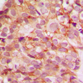 COL5A3 / Collagen V Alpha 3 Antibody - Immunohistochemical analysis of Collagen 5 alpha 3 staining in human breast cancer formalin fixed paraffin embedded tissue section. The section was pre-treated using heat mediated antigen retrieval with sodium citrate buffer (pH 6.0). The section was then incubated with the antibody at room temperature and detected using an HRP conjugated compact polymer system. DAB was used as the chromogen. The section was then counterstained with hematoxylin and mounted with DPX.