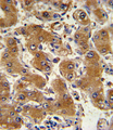 COL6A1 / Collagen VI Alpha 1 Antibody - Formalin-fixed and paraffin-embedded human hepatocarcinoma with COL6A1 Antibody , which was peroxidase-conjugated to the secondary antibody, followed by DAB staining. This data demonstrates the use of this antibody for immunohistochemistry; clinical relevance has not been evaluated.