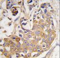 COL9A1 / Collagen IX Antibody - Formalin-fixed and paraffin-embedded human breast carcinoma tissue reacted with COL9A1 antibody , which was peroxidase-conjugated to the secondary antibody, followed by DAB staining. This data demonstrates the use of this antibody for immunohistochemistry; clinical relevance has not been evaluated.