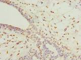 COLGALT2 / GLT25D2 Antibody - Immunohistochemistry of paraffin-embedded human breast cancer using antibody at dilution of 1:100.