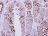COLQ Antibody - IHC of paraffin-embedded Colon ca, using COLQ antibody at 1:500 dilution.