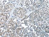 COMMD6 Antibody - Immunohistochemistry of paraffin-embedded Human esophagus cancer tissue  using COMMD6 Polyclonal Antibody at dilution of 1:45(×200)