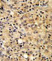 COMP / THBS5 Antibody - Formalin-fixed and paraffin-embedded human prostate carcinoma reacted with COMP Antibody , which was peroxidase-conjugated to the secondary antibody, followed by DAB staining. This data demonstrates the use of this antibody for immunohistochemistry; clinical relevance has not been evaluated.